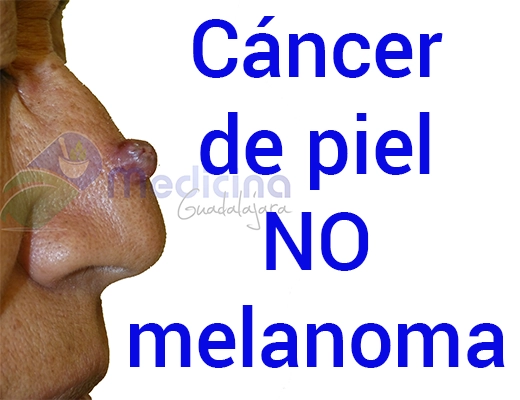 Especialista en Tratamiento de Cáncer de piel en Guadalajara Jalisco Mexico, Biopsia de cáncer de piel